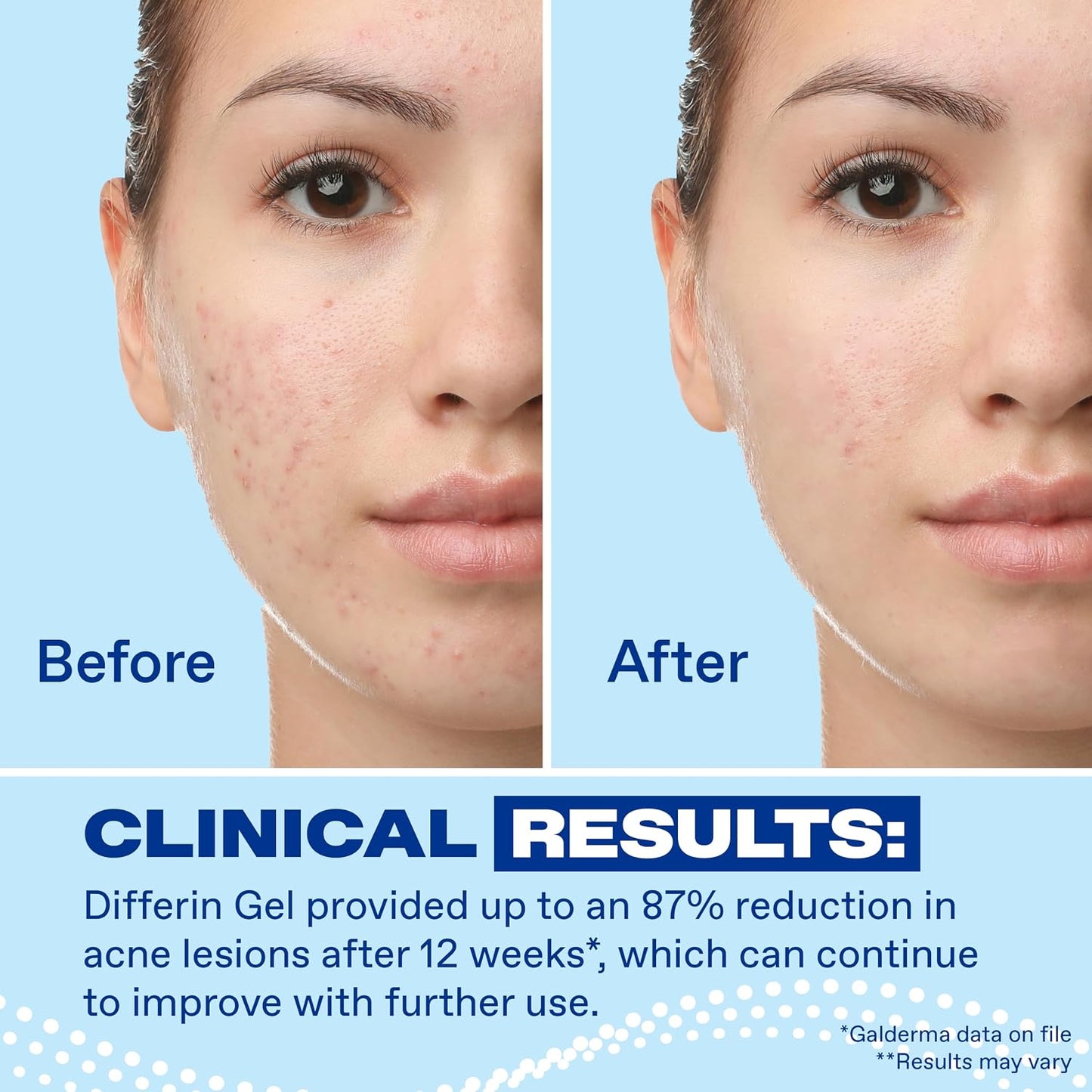 HOTDifferin Acne Treatment Gel, 30 Day Supply, Retinoid Treatment for Face with 0.1% Adapalene, Gentle Skin Care for Acne Prone Sensitive Skin, 15g Pump (Packaging May Vary)