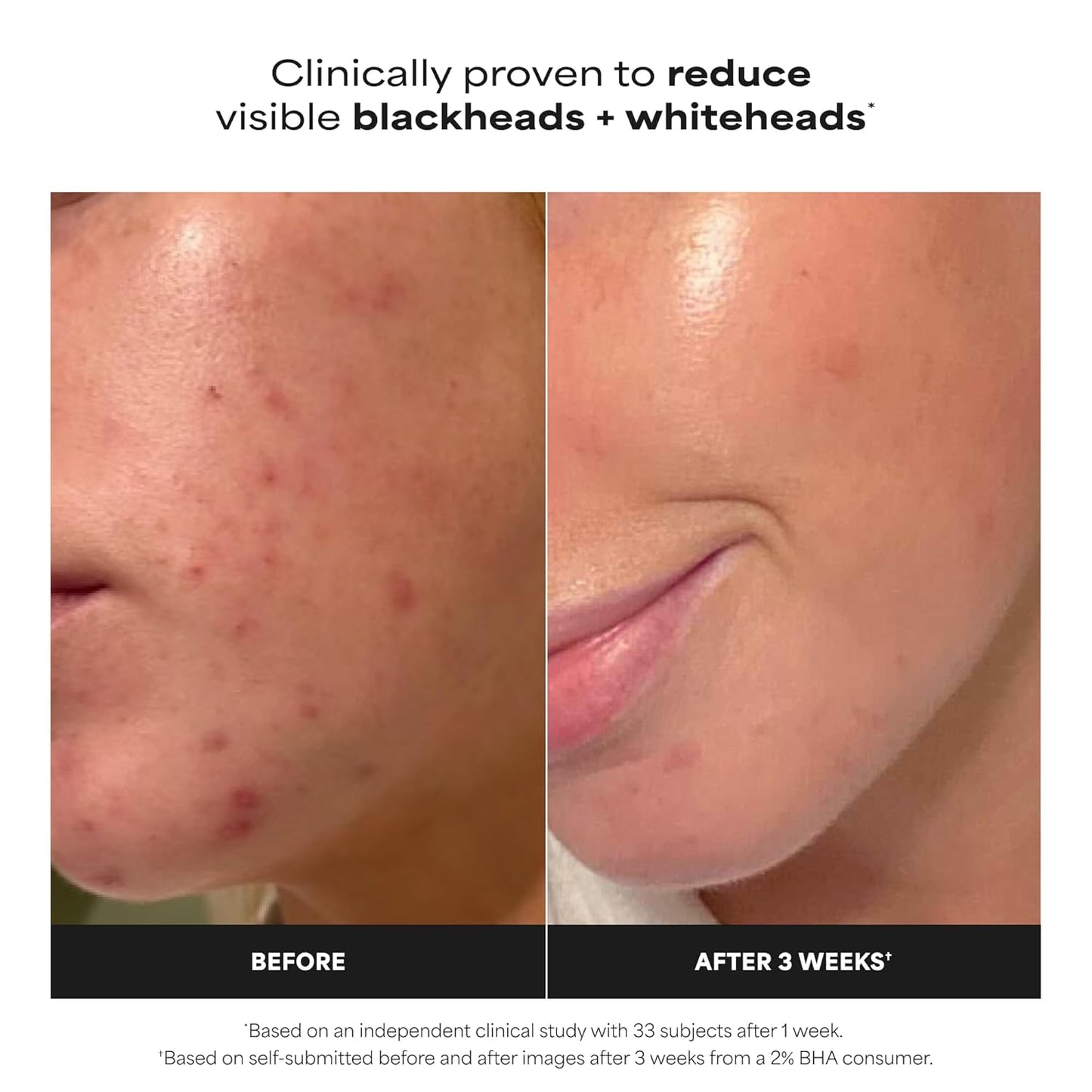 HOTPaula's Choice SKIN PERFECTING 2% BHA Liquid Exfoliant with Salicylic Acid, Facial Polish for Pores, Wrinkles & Fine Lines, Suitable for Blackhead-Prone Skin, Fragrance-Free