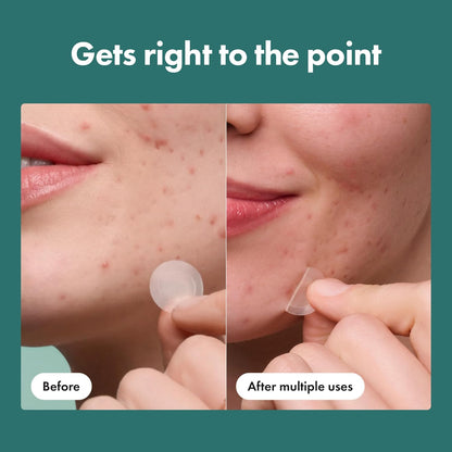 HOTMighty Patch Hero Cosmetics Micropoint Acne Pimple Patches, 8 Ct | For Early Stage Zits & Hidden Blemishes; Hydrocolloid with Salicylic Acid, Niacinamide, Cica; 395 Micropoints; Acne Stickers