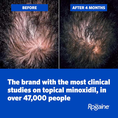 HOTMen's Rogaine 5% Minoxidil Topical Foam, Unscented, 3 Mo Supply, 3x 2.11 Oz