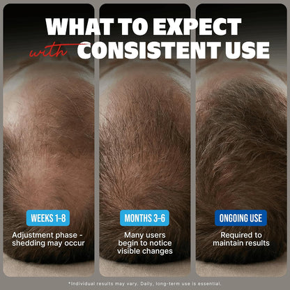 HOTMinoxidil Liquid Extra Strength Hair Regrowth Treatment for Men, 5% Topical Solution, 6 Months Supply - Dropper Applicator and Bonus Free Instructional Guide Included