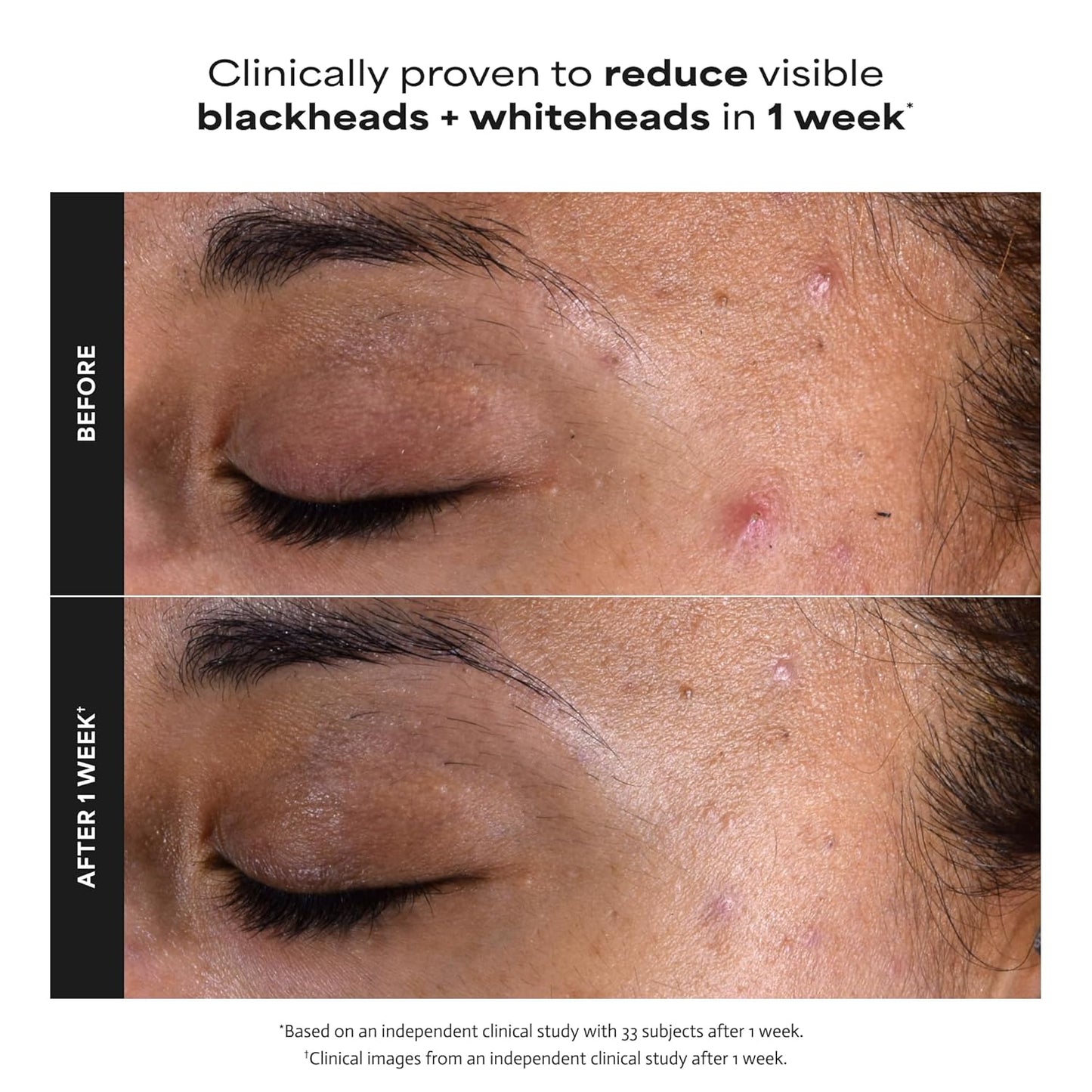 HOTPaula's Choice SKIN PERFECTING 2% BHA Liquid Exfoliant with Salicylic Acid, Facial Polish for Pores, Wrinkles & Fine Lines, Suitable for Blackhead-Prone Skin, Fragrance-Free