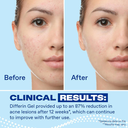 HOTDifferin Acne Treatment Gel, 30 Day Supply, Retinoid Treatment for Face with 0.1% Adapalene, Gentle Skin Care for Acne Prone Sensitive Skin, 15g Pump (Packaging May Vary)