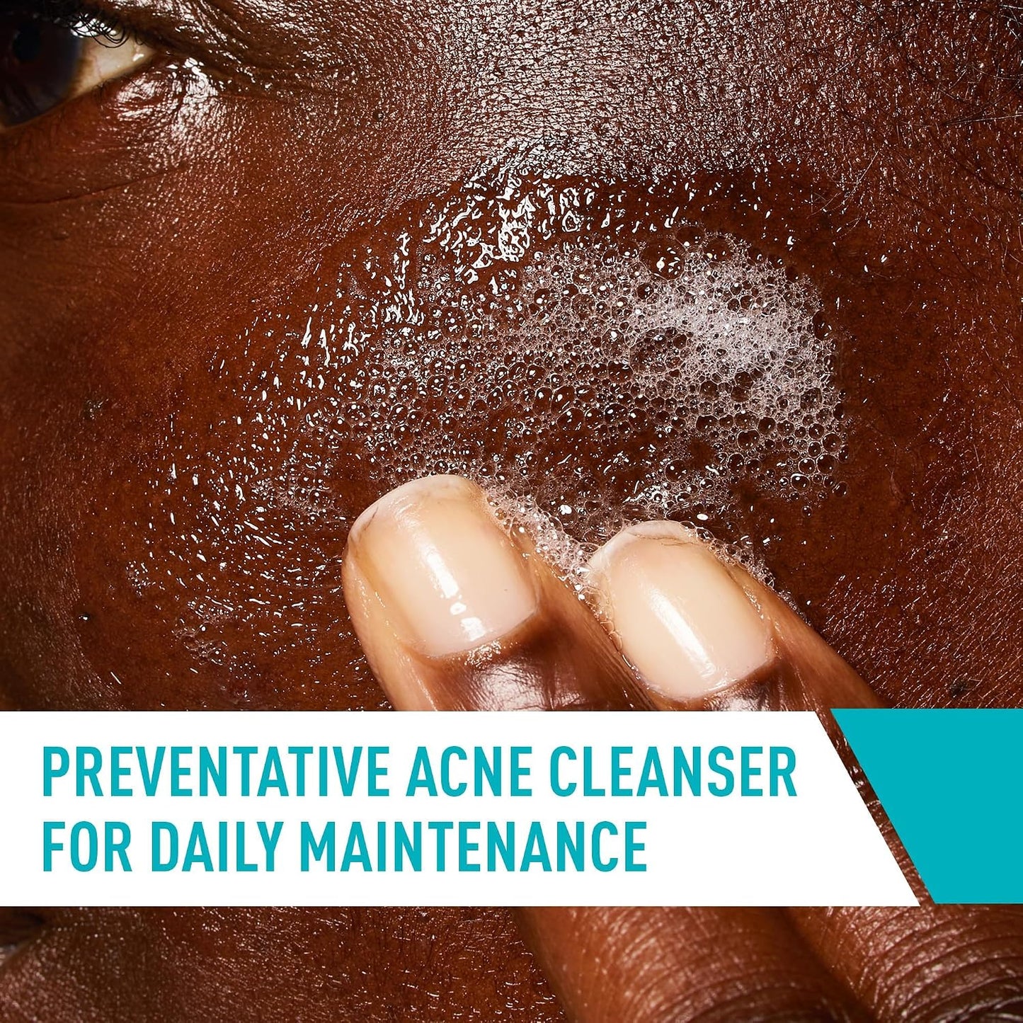 HOTCeraVe Acne Treatment Face Wash, Salicylic Acid Cleanser with Purifying Clay, Niacinamide, and Ceramides, Pore Control and Blackhead Remover, 8 Ounce